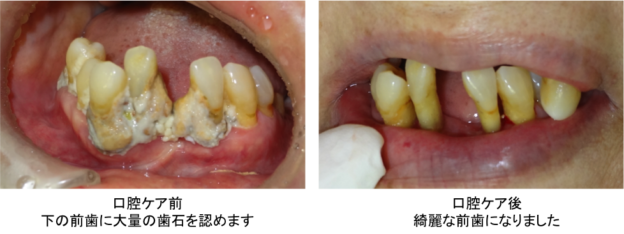前歯 歯茎 腫れ