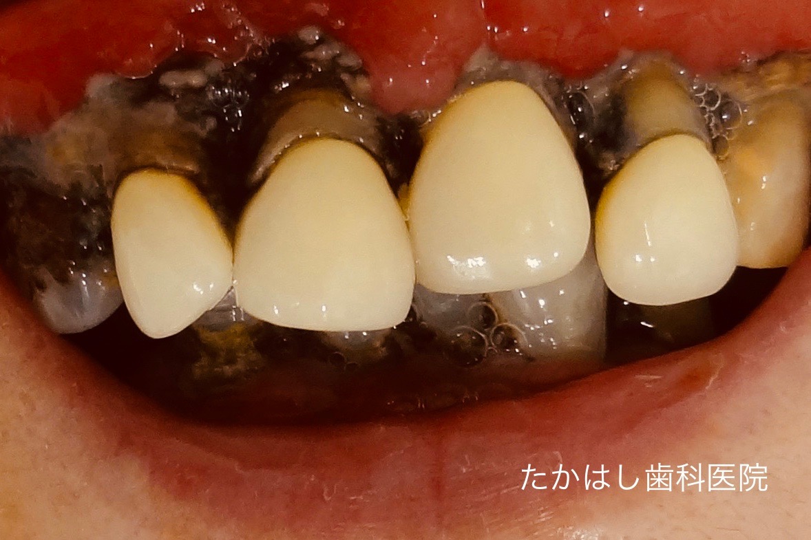 歯石を放置した歯槽膿漏の前歯