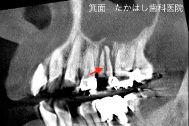 歯冠,歯根破折