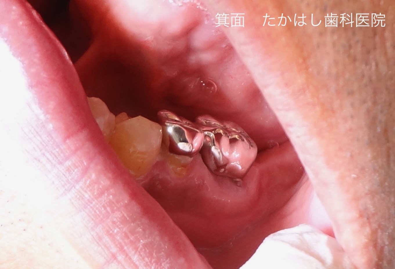 小臼歯と大臼歯を、銀歯で連結固定した写真