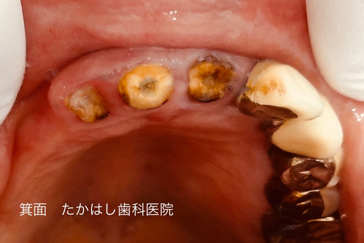 歯根破折の接着修復 ボロボロの虫歯を治す 箕面市 千里中央の口腔外科